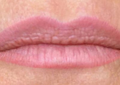 Korrektur einer minderwertigen Lippenfarbe